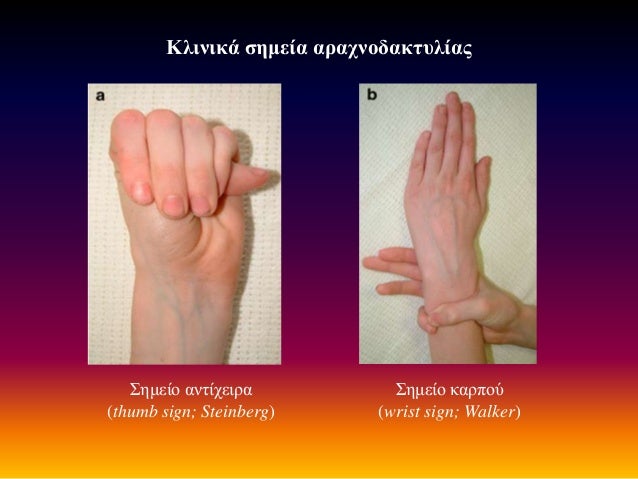 wrist and thumb sign Boob view between legs